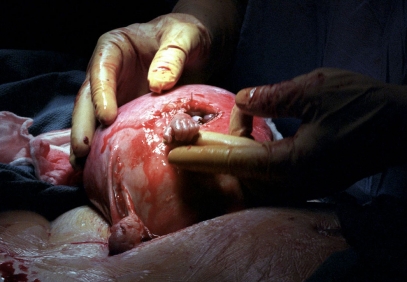 Operation am Foetus